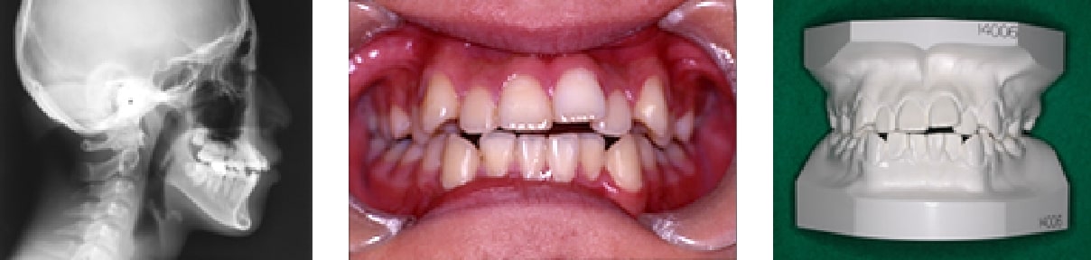 セファロ（頭部X線規格写真）・口腔内写真・歯型模型　等